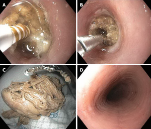 Endoscopic view representing foreign bodies in the oesophagus. unusual surgical callout